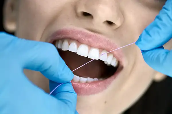 A tooth cleaning being performed on a woman with floss at Highridge Dental Care in Folsom, CA