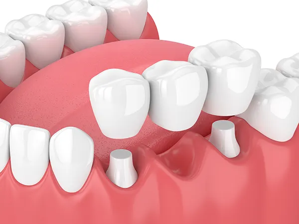 3D rendering of a dental bridge being placed over a missing tooth gap illustrated by Highridge Dental Care in Folsom, CA