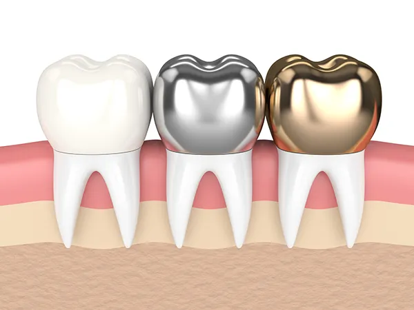 3D rendered cross-section view of three teeth with dental crowns made of different materials at Highridge Dental Care in Folsom, CA