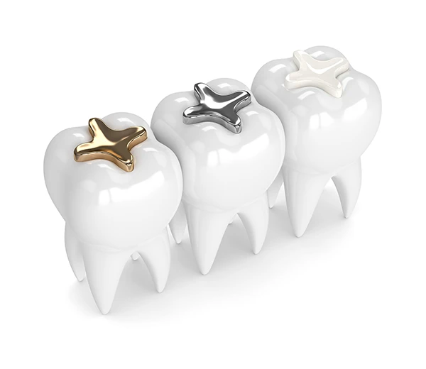 Image of a dental filling.