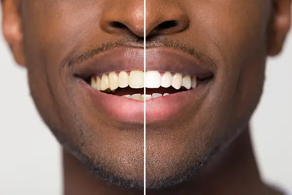 Close up comparison of before and after teeth whitening treatment on a man's smile at Highridge Dental Care in Folsom, CA